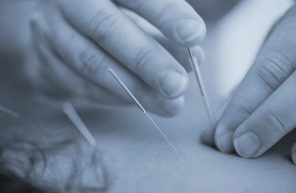 Handen van een acupuncturist die drie naalden in de rug van een cliënt inbrengen